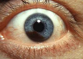 Tumor Intraokular